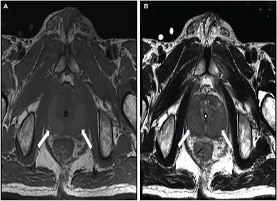 Case report: Prostatic malakoplakia: a rare disease that has a profile mimicking prostate cancer